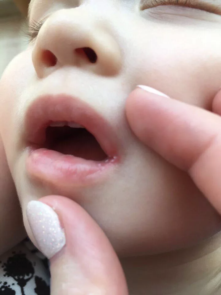 Мозоль на губе у ребёнка 2х лет