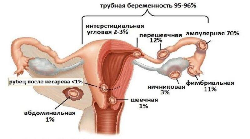 Почему возникает внематочная беременность: причины и факторы риска