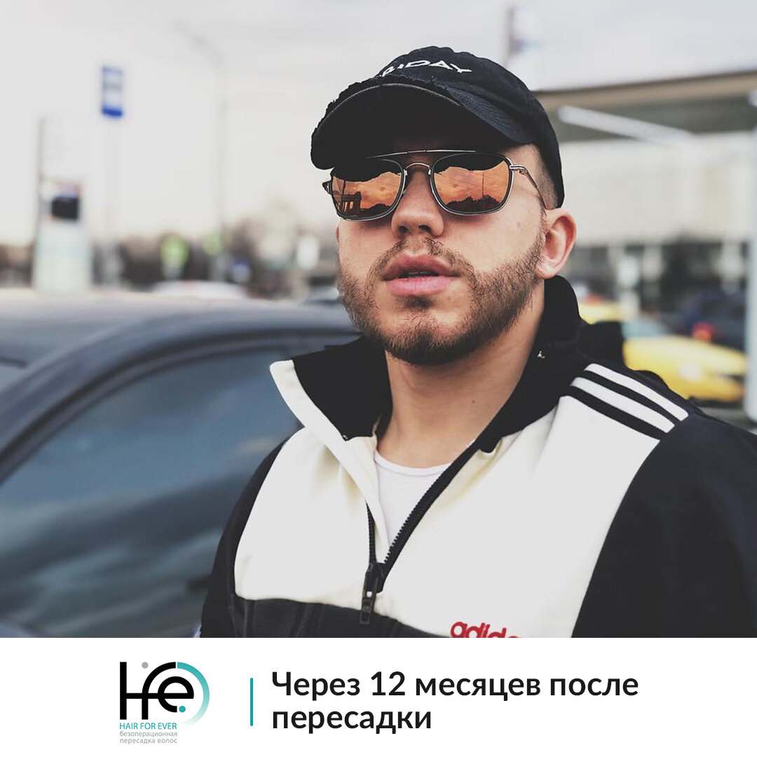 Год назад известный актер и блогер Сергей Романович обратился в клинику HFE, чтобы осуществить свое желание и стать «настоящим бородачом»🔥 Мы провели Сергею процедуру пересадки фолликулов с зоны затылка в область бороды. По прошествии 12 месяцев можно увидеть полный результат, который блогер и опубликовал у себя на страничке. Как вам такое преображение? 😍

Посмотреть как проходила пересадки и сколько времени потребовалось на восстановление реципиентной и донорской зоны, можно на нашем YouTube-канале или на сайте. 
