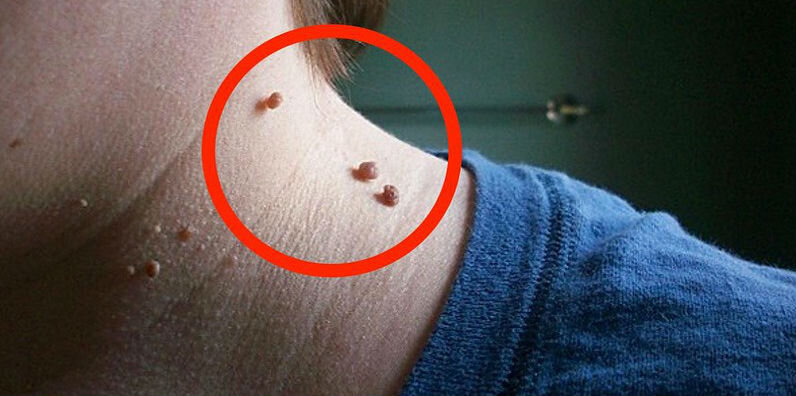 Фиброма - fibroma