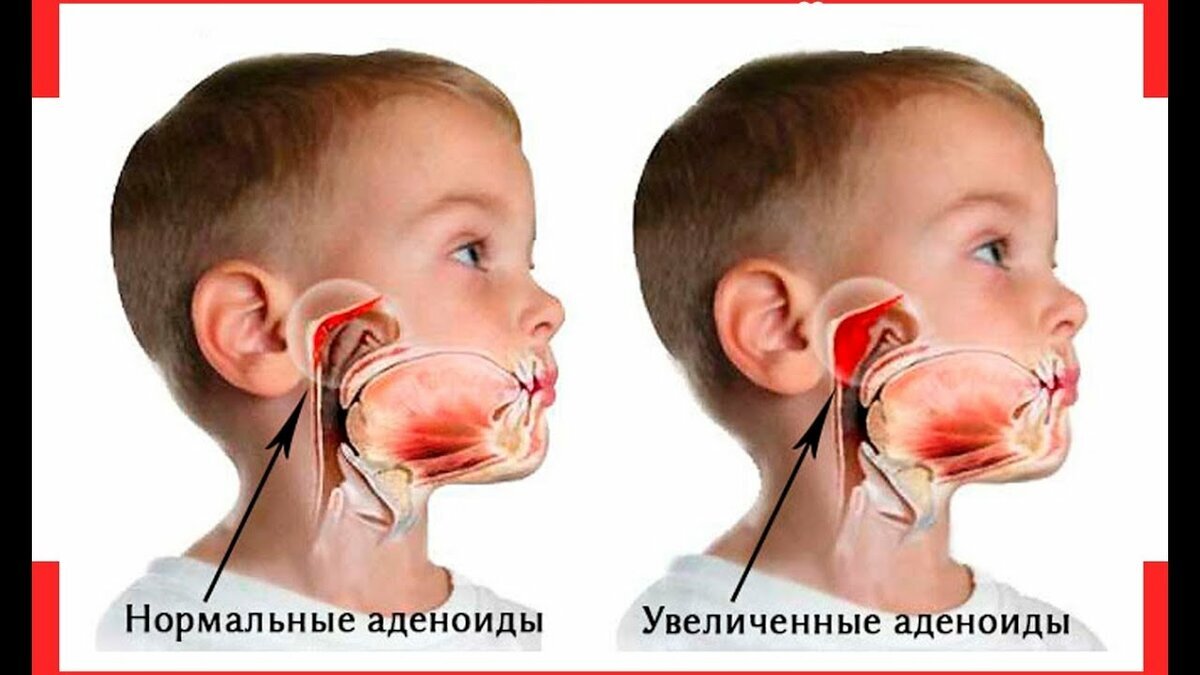 разрастание тканей миндалин фото