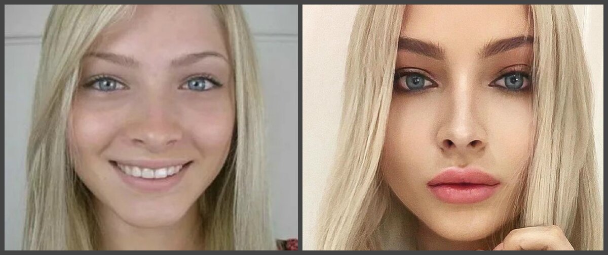 Алена сделала свою внешность под современные стандарты красоты и практически перестала быть похожей на себя прежнюю.