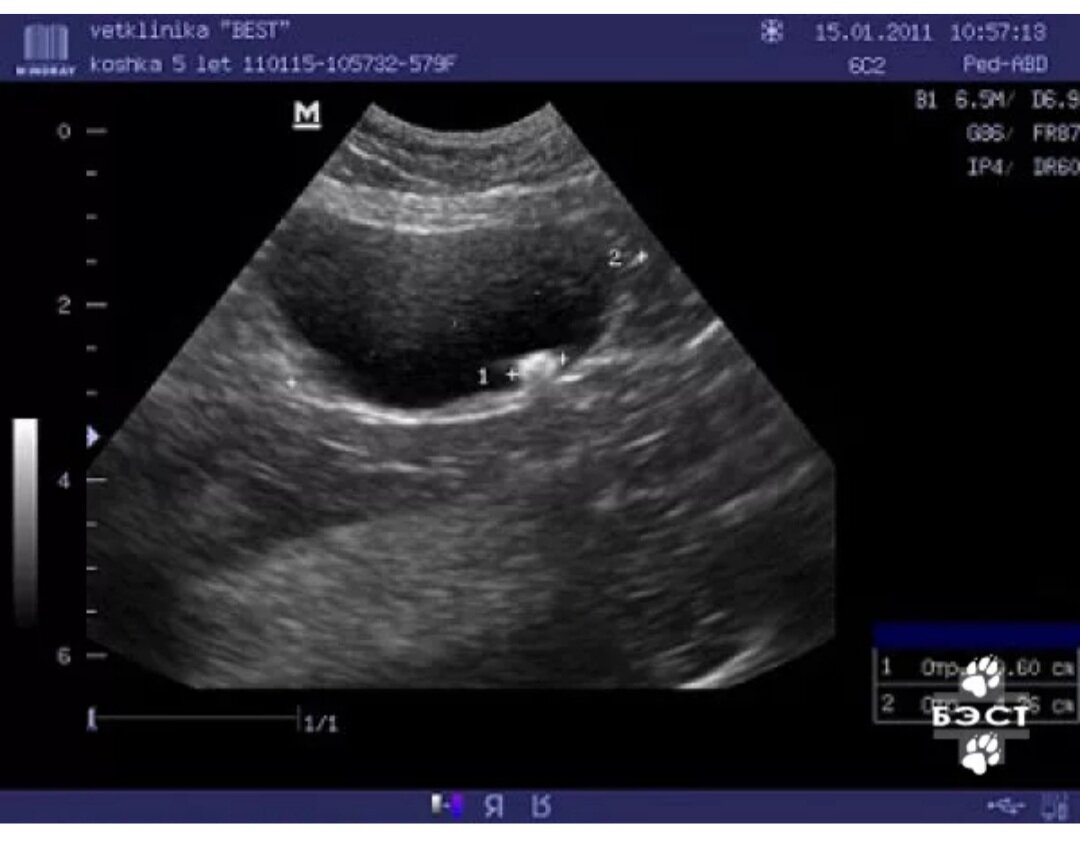 Камень в мочевом пузыре (фото из интернета)