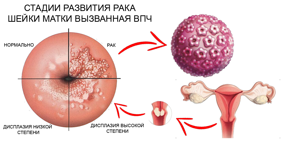 9 фактов о ВПЧ, которые должна знать каждая женщина | DoctorAISt Врач ...