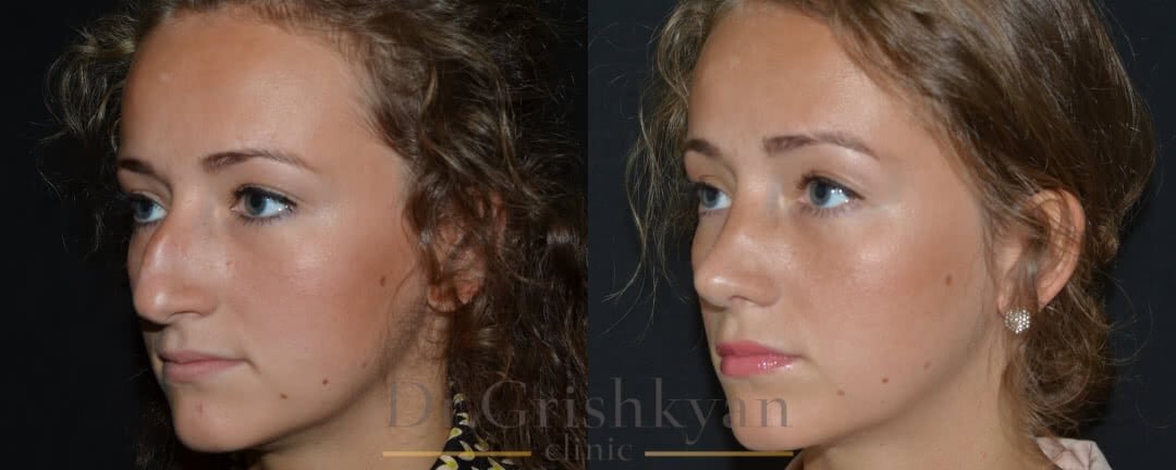 Ринопластика кривого носа фото до и после. Фото с сайта Д.Р. Гришкяна. Имеются противопоказания, требуется консультация специалиста