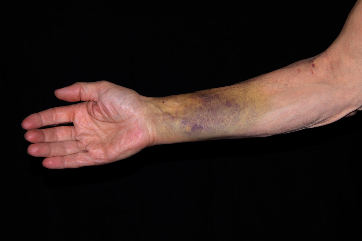 Почему появляются синяки. ФОТО: Siegra Asmoel/Globallookpress 