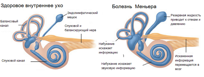 Как я победил болезнь Меньера - отзывы и истории больных