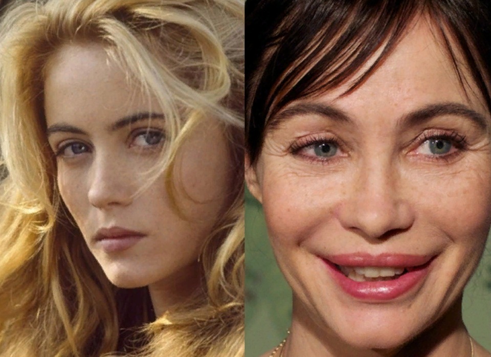 Первая операция в 27 лет - увеличение губ. Все бы ничего, но актриса ещё не раз прибегала к пластике пытаясь исправить последствия предыдущих. 