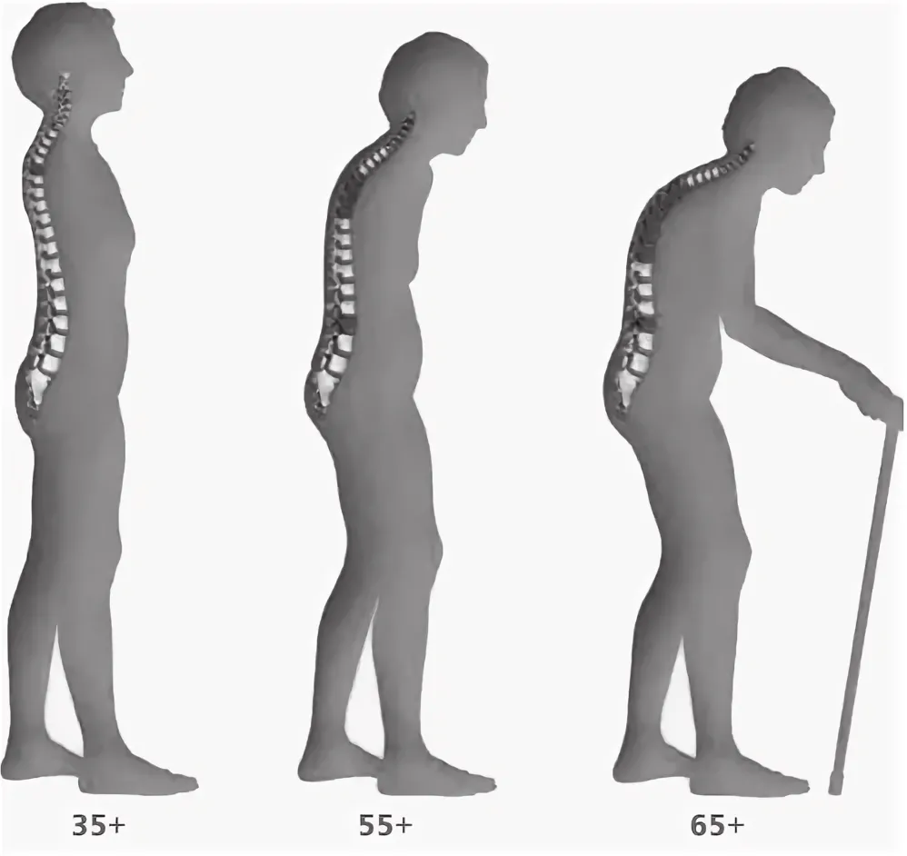 уменьшение роста при остеопорозе.