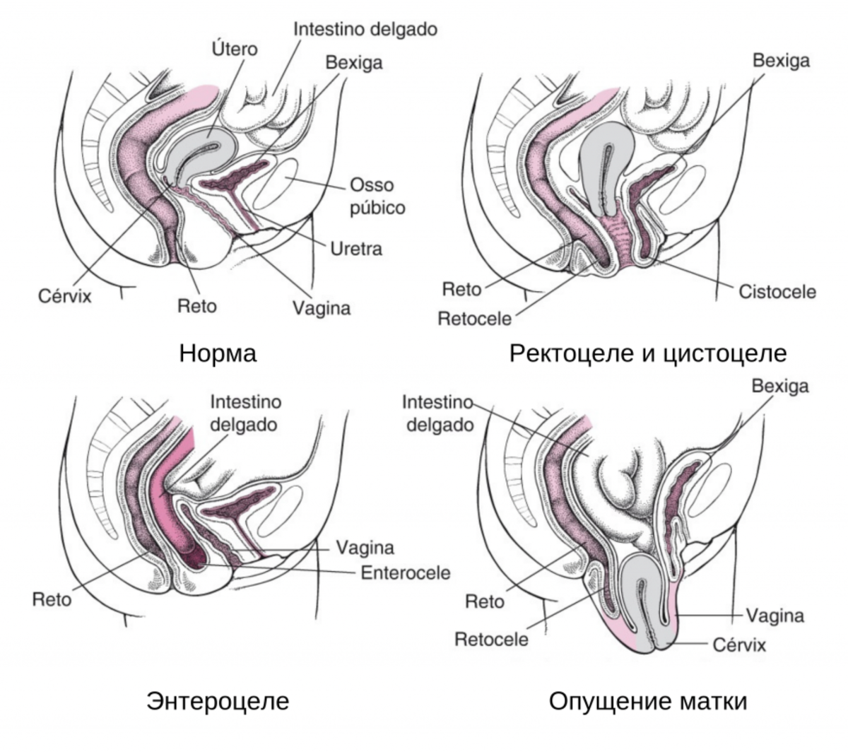Допустить опущение органов малого таза легче, чем кажется, а вот решать эту проблему, к сожалению, порой приходится уже только операционным путем.