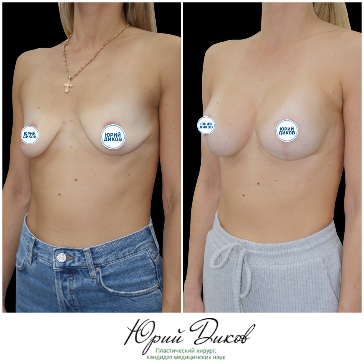 импланты для груди третьего размера фото 80