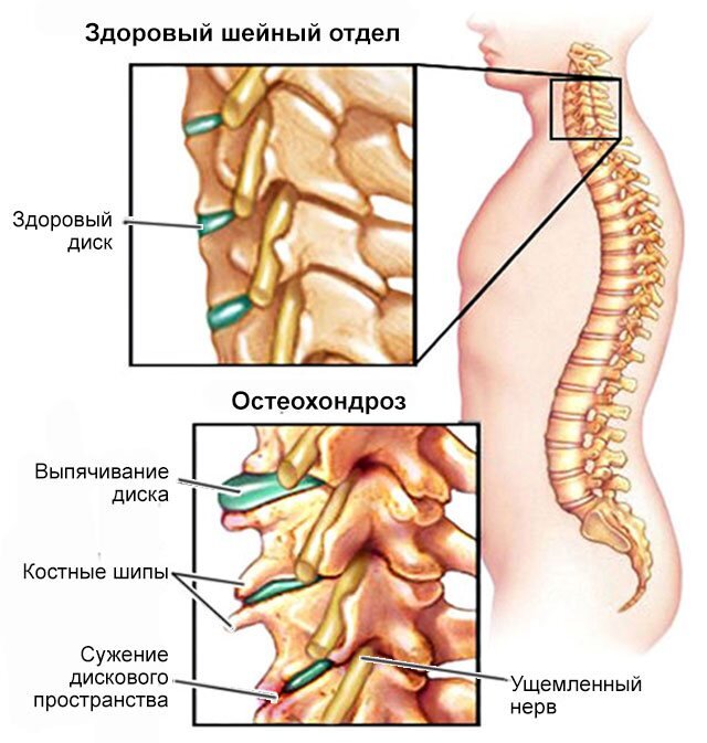 Болит шея и голова