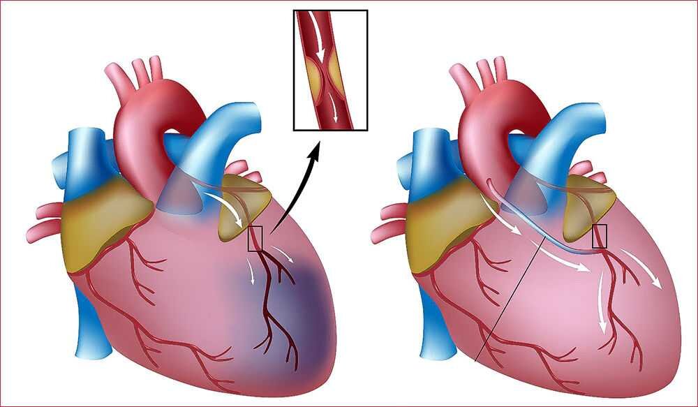 Наглядное изображение создания "обходного пути". Фото из Яндекс.Картинки.