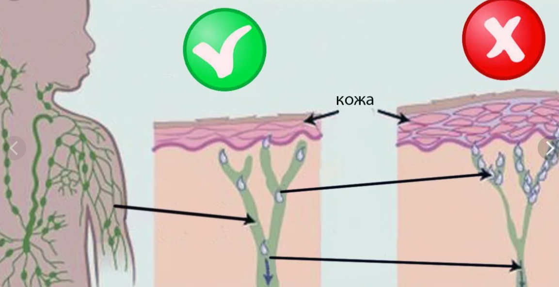Нарушена лимфа. Лимфатическая система застой лимфы. Застой лимфатической системы нарушение. Лимфатическая система под кожей.