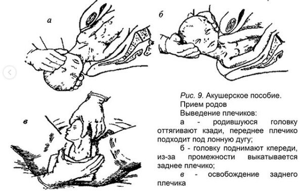Тест затрудненные роды дистоция вследствие предлежания