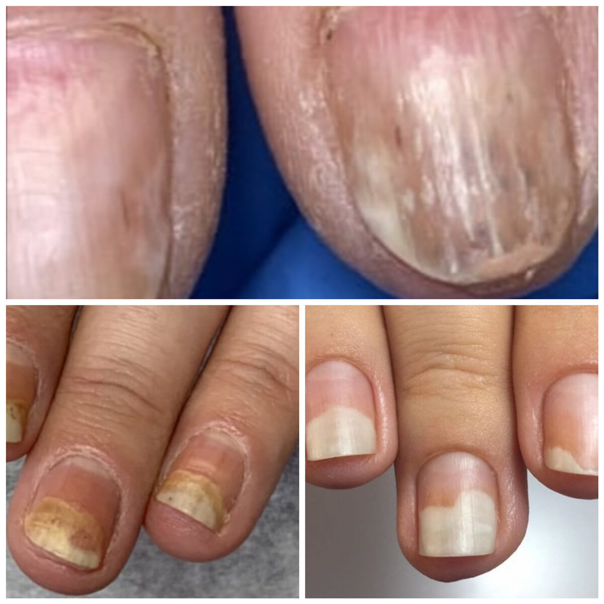 Последствия ожогов ногтевой пластины