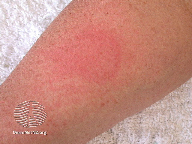 Через 5 минут пятно увеличивается (фото из dermnetnz.org)