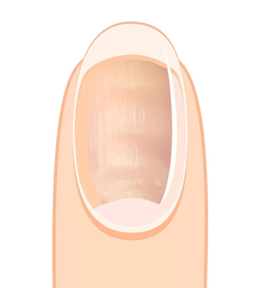 Схема борозд на ногтях