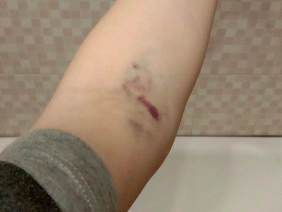 Этот синяк появился на следующий день после особо болезненного взятия крови. Через пару дней он разросся так, что вся площадь сгиба была синей.