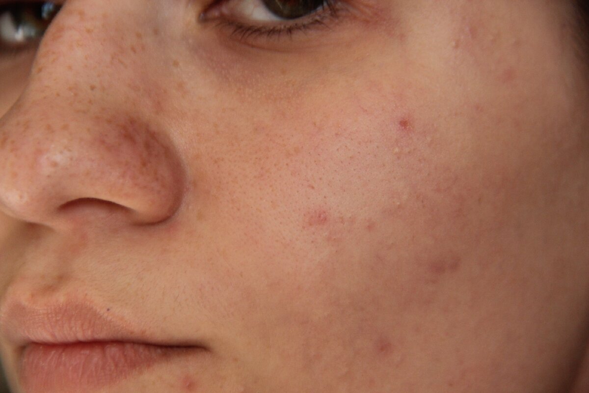 Такой была моя кожа, когда я неправильно за ней ухаживала