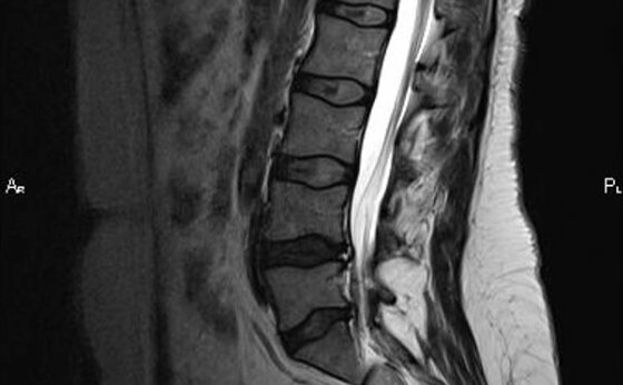 Pe imaginea RMN: semne de osteocondroză la nivelul L4-L5, L5-S1