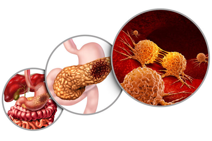     По статистике, почти 95% больных раком поджелудочной железы умирает. Фото: Mount Elisabeth Hospitals