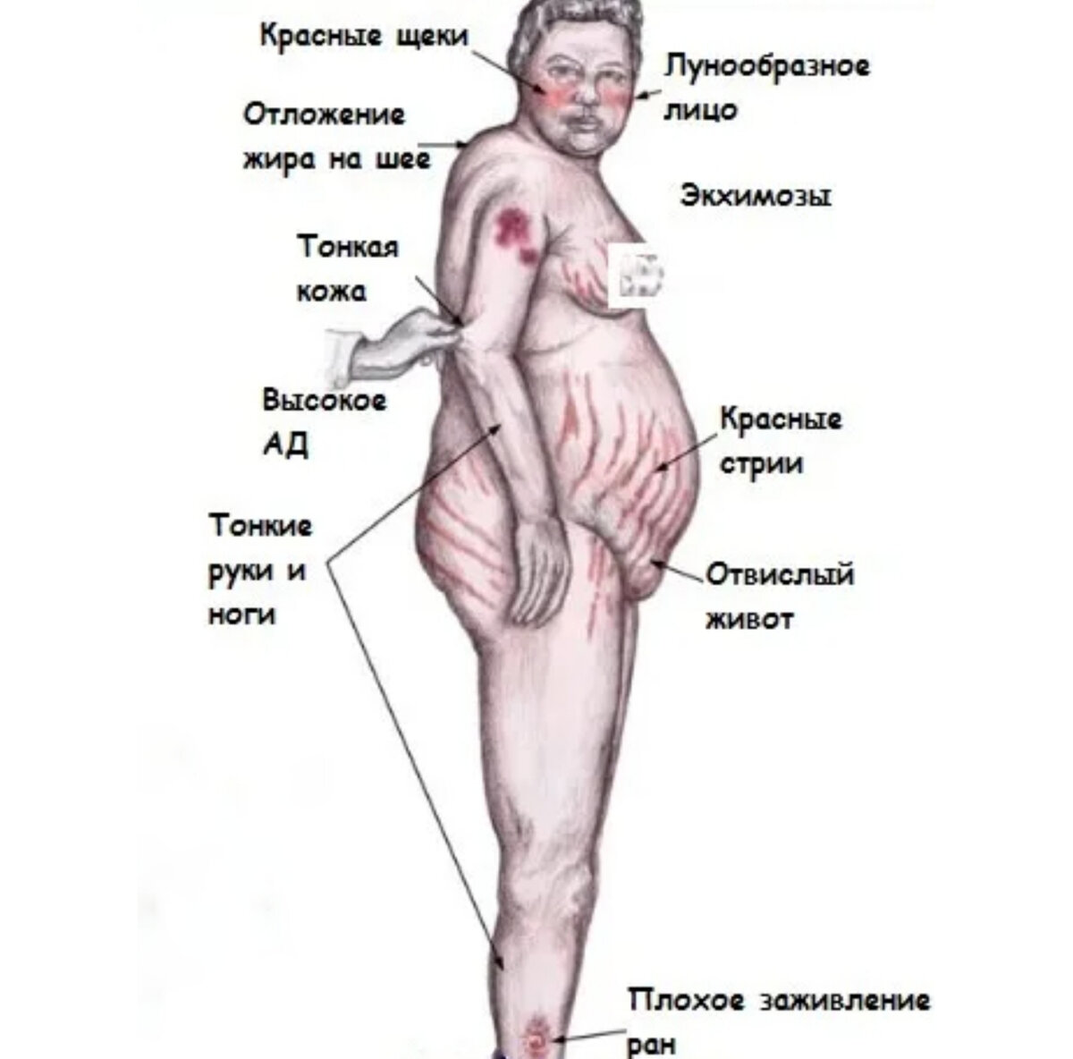 В острой стадии растяжки красные или лиловые. Когда же кортизол снижается, они светлеют, но так и остаются, их по телу очень много 