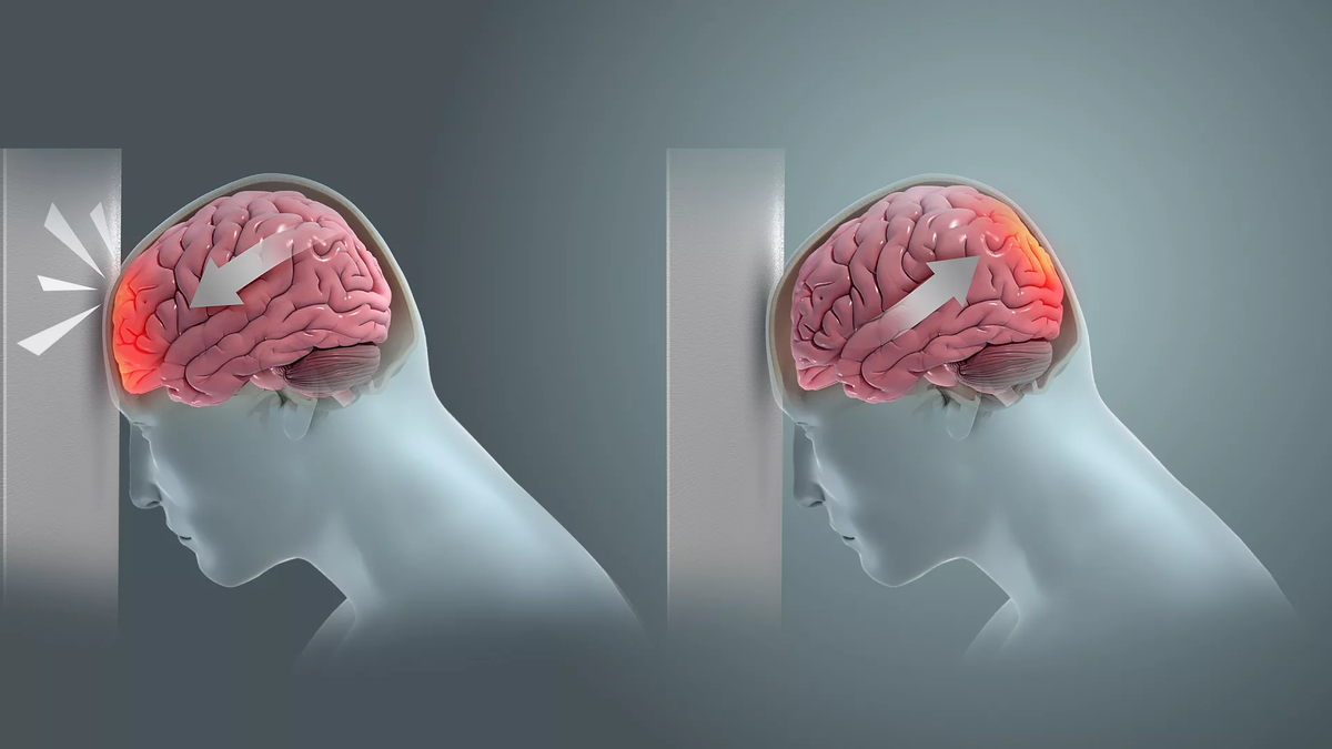 6 последствий сотрясения мозга: проблема серьезнее, чем вам кажется | О  здоровье: с медицинского на русский | Дзен