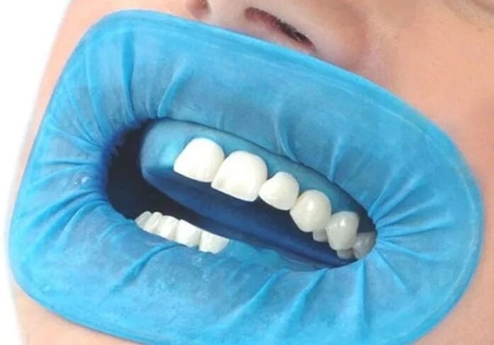 Использование коффердама при отбеливании зубов