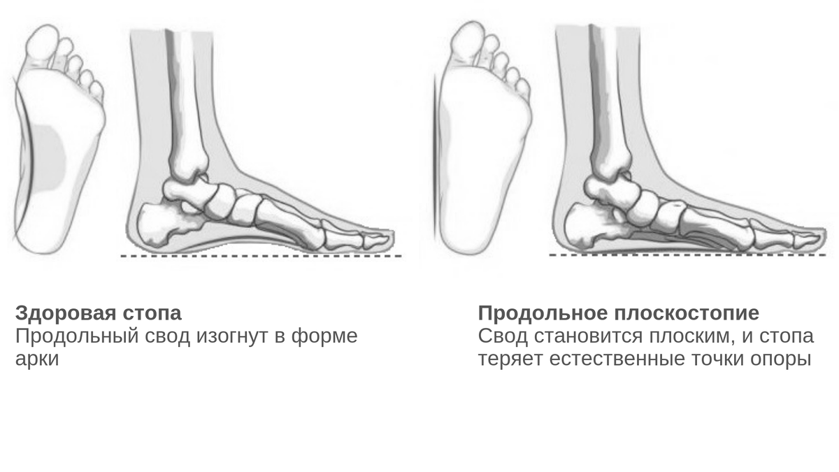 Как возникает плоскостопие и чем оно опасно?