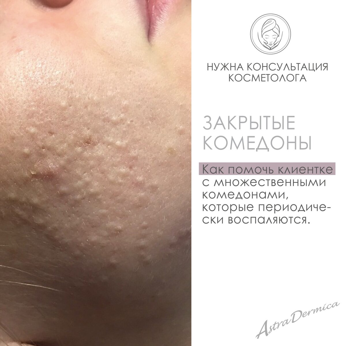 Как избавиться от закрытых комедонов на лице? | DermaQuest | Дзен