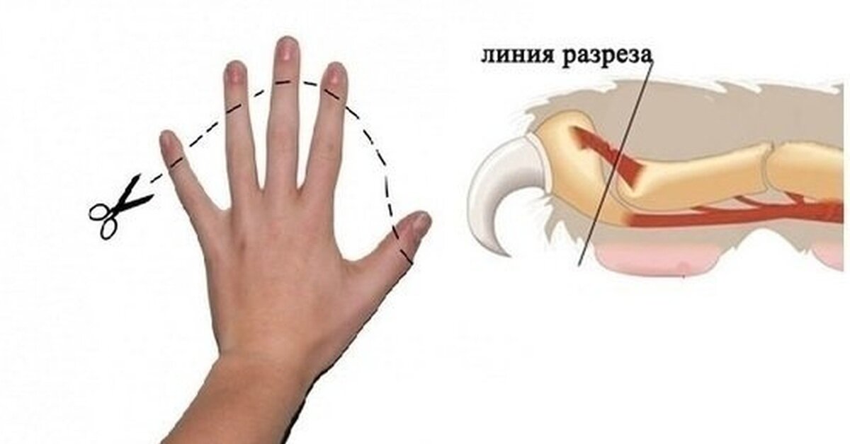 схема удаления когтей на примере человеческой руки. фото из интернета