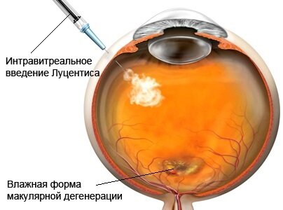 Инъекция Луцентиса при влажной макулярной дегенерации сетчатки