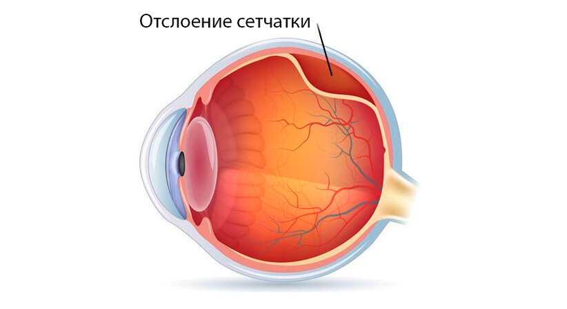 Как выглядит отслойка сетчатки глаза Близорукость. В каких ситуациях офтальмологи бессильны? Эксимер, офтальмологичес