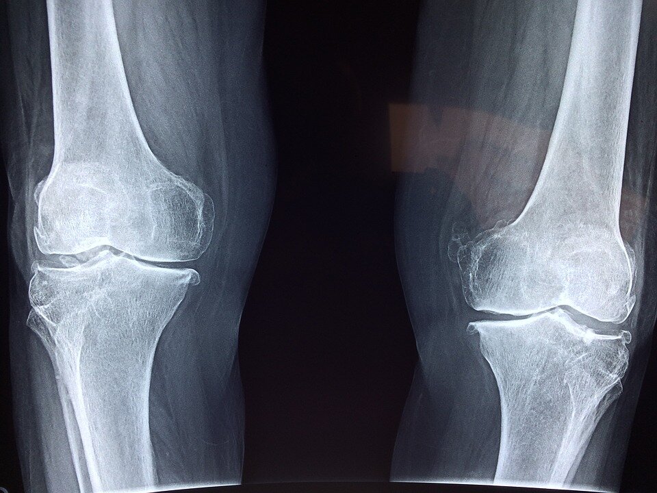 https://cdn.pixabay.com/photo/2017/04/23/05/43/knee-2253047_960_720.jpg