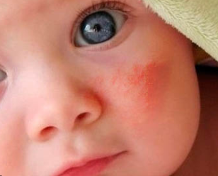 Аллергия у детей: как лечить расскажет доктор Комаровский