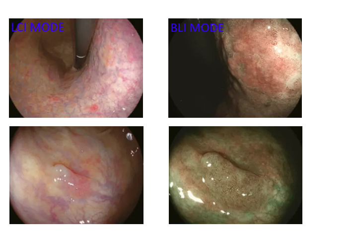 Режимы LCI (Linked Color Imaging) и BLI (Blue Light Imaging)