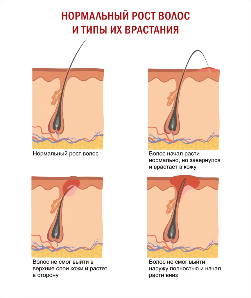 Нормально расти. Типы вросших волос плакат. Вросшие волосы плоский Тип. Вросшие волосы типы вросших волос.