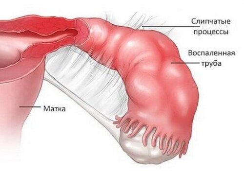 Спаечная болезнь. Диагностика и лечение спаечной болезни – Гинеко – клиника гинекологии