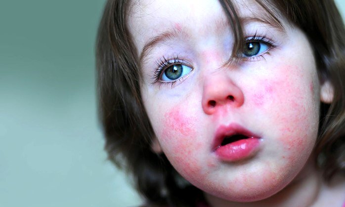 Крапивница у детей | Что врач говорит | Дзен