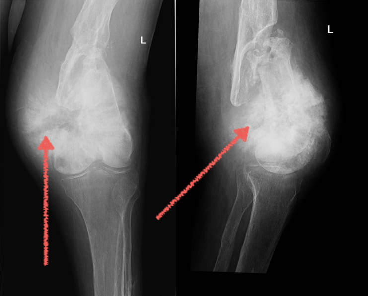 Остеосаркома