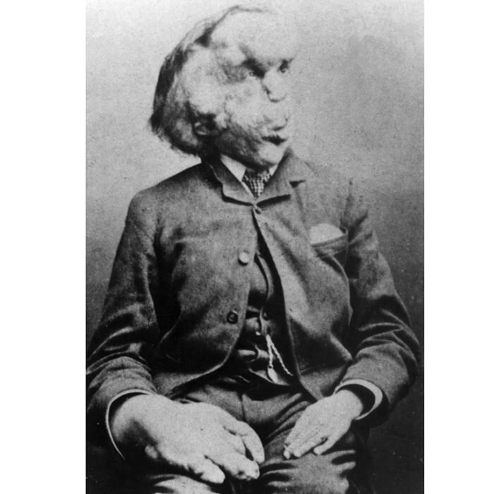 Джозеф Меррик постоянно высмеивали на протяжении всего его детства и большей части своей взрослой жизни.