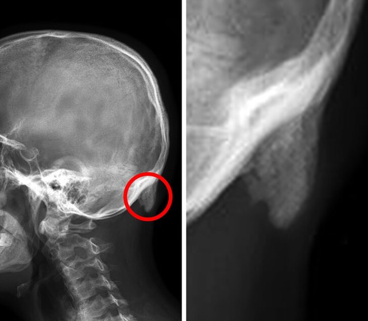Отросток отчётливо виден на рентгеновском снимке