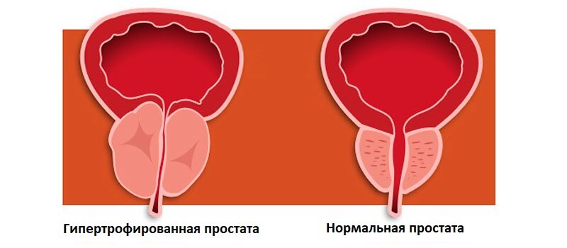 Слева гипертрофически-измененная простата сдавливает мочеиспускательный канал.