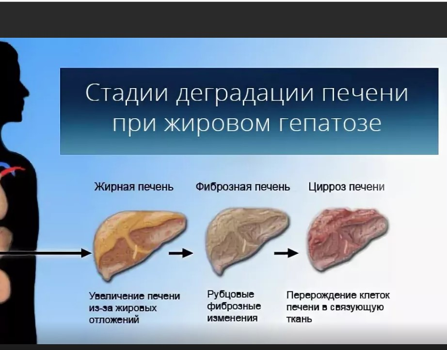 При жировом гепатозе печени какие