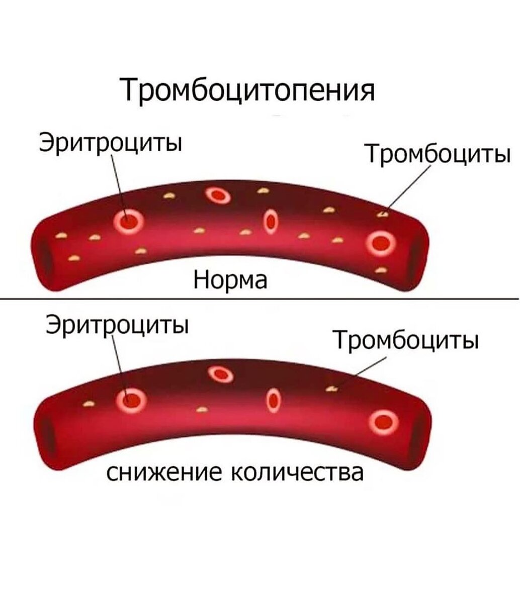 Тромбоциты что это. Тромбоцитопения характерна для. Тромбоцитопения картинки.