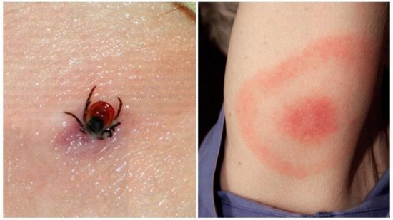 
При обнаружении таких покраснений после удаления клеща нужно прибегать к лечению боррелиоза (болезнь Лайма)