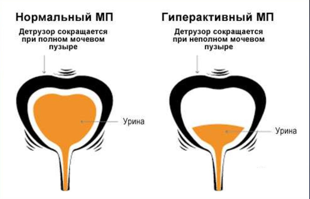 Гиперактивный мочевой пузырь: что это значит, и как лечить