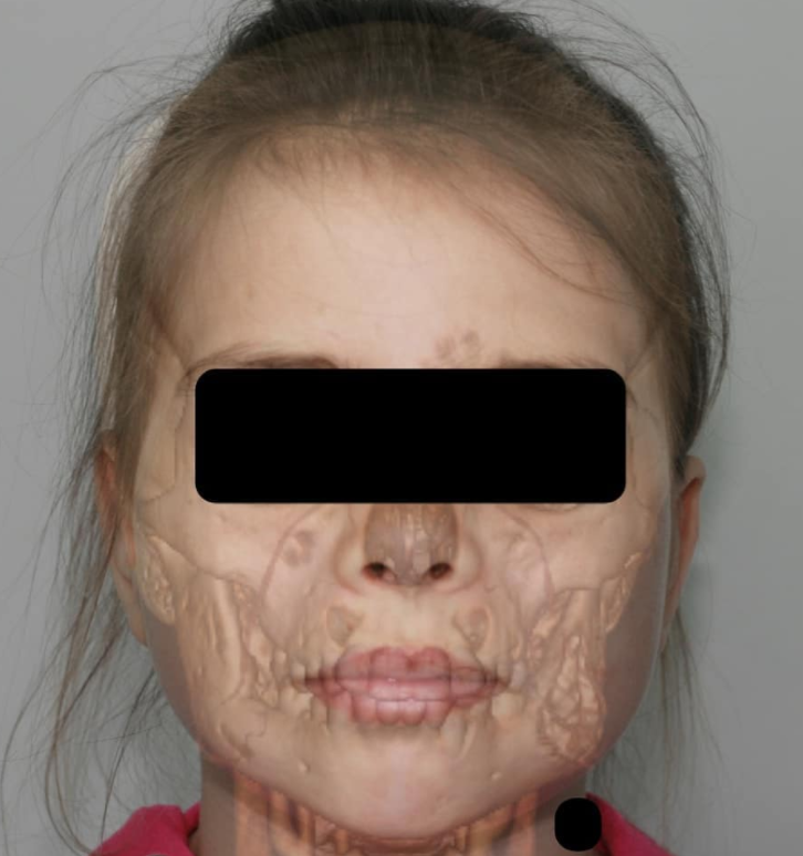 Херувизм до лечения. На фото наложен снимок КТ.  Личный архив А. Ю. Кугушева.