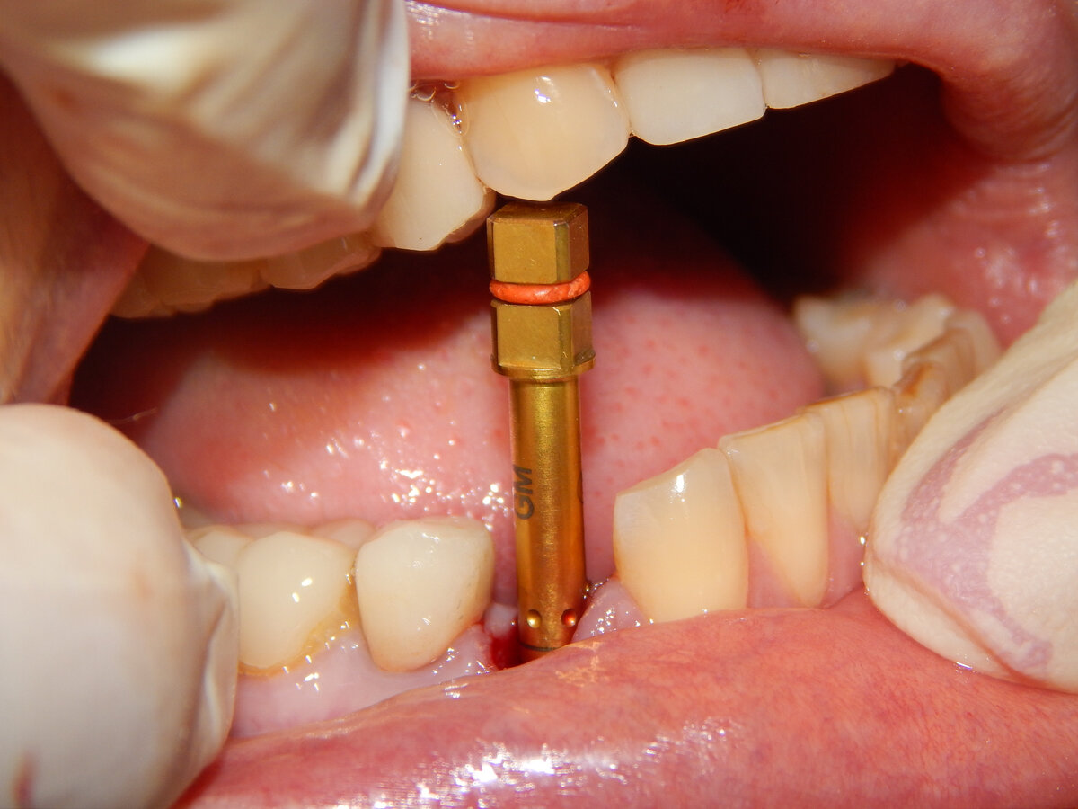 На фото имплантовод (то чем вкручивают имплантат)